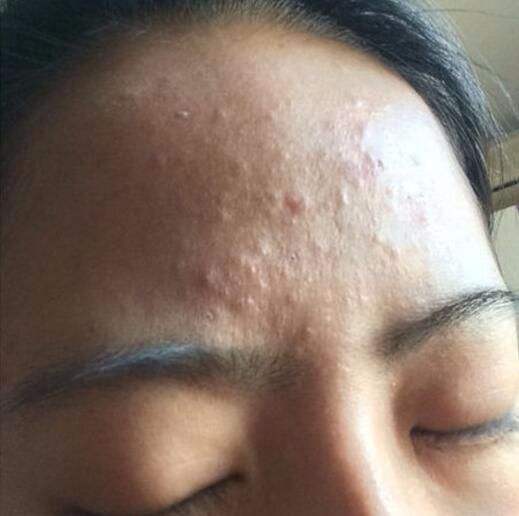 影响痘痘的十大因素,滋生痘痘的十大禁忌