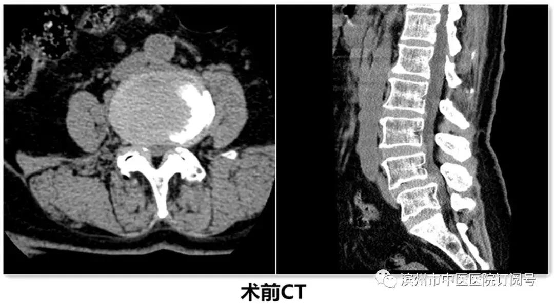 椎间盘突出保守治疗,椎间盘治疗视频大全