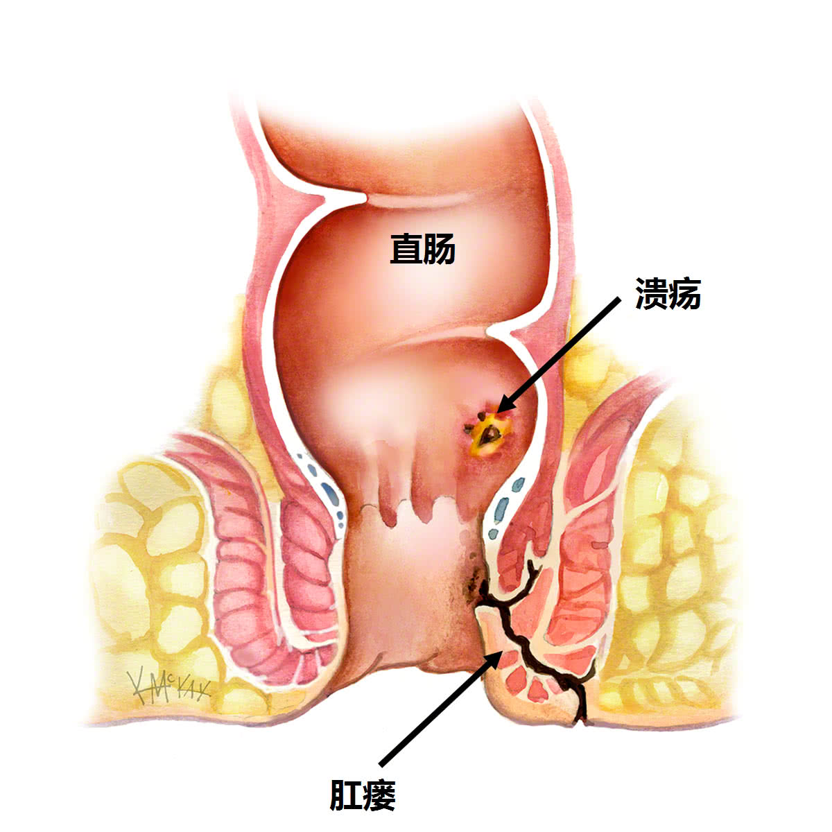 消化内科可以看肛瘘吗,肛瘘挂消化外科可以吗