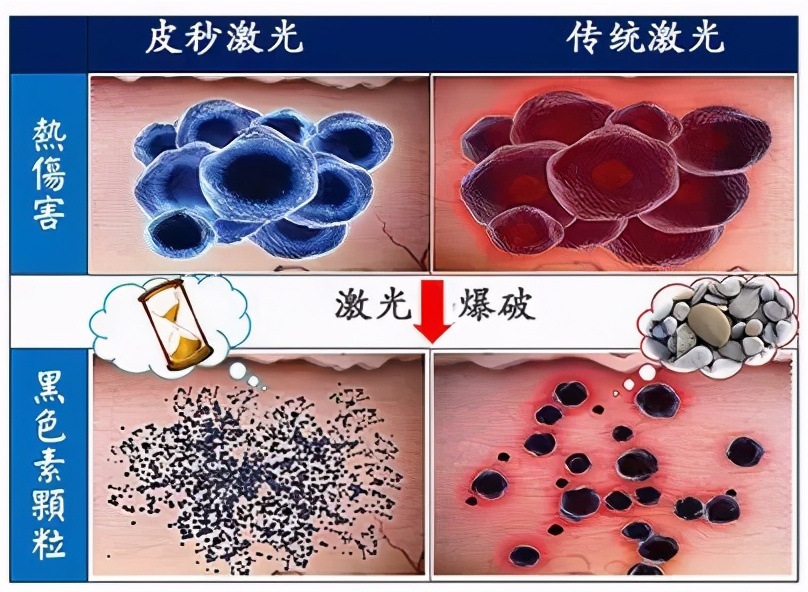 脸上长斑是激光还是用祛斑产品好,50岁年龄脸上长斑怎样能祛斑