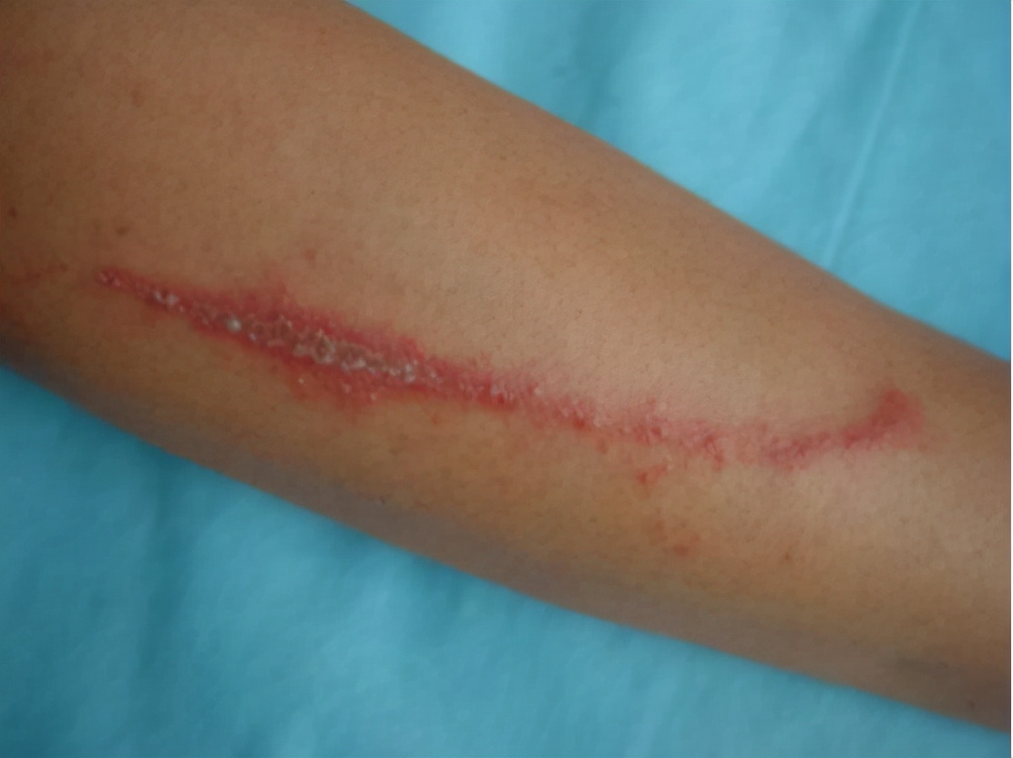 被隐翅虫咬伤有多可怕,被隐翅虫咬后症状图片及治疗方法