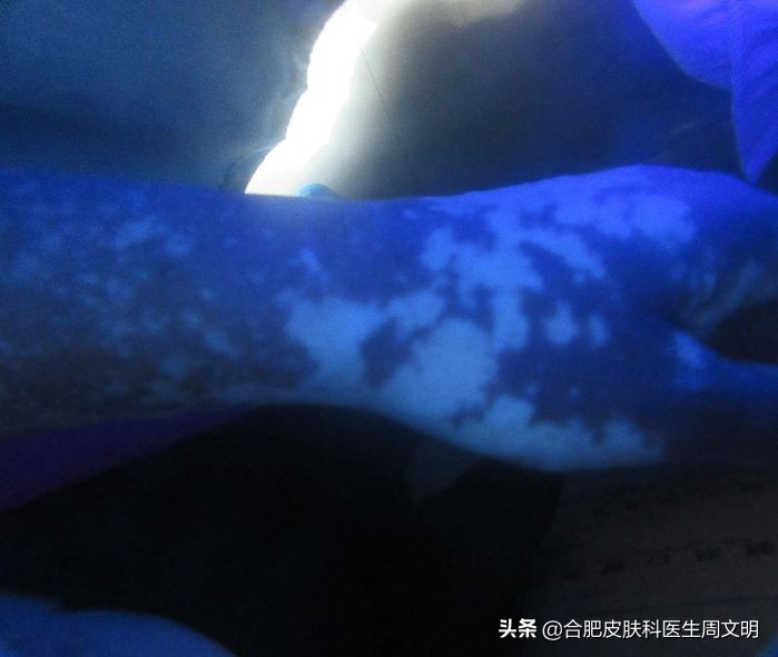 白癜风是皮肤病难治的第几种,鼻子下方嘴巴上的白癜风难治吗