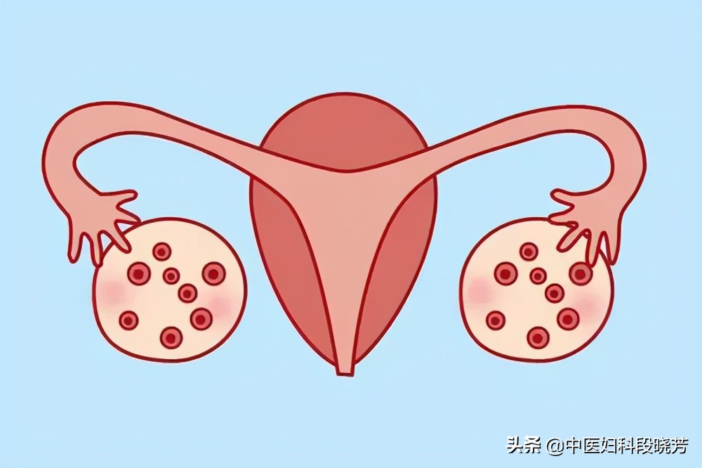 多囊卵巢综合征诊断思路,中医段晓芳看多囊效果怎么样