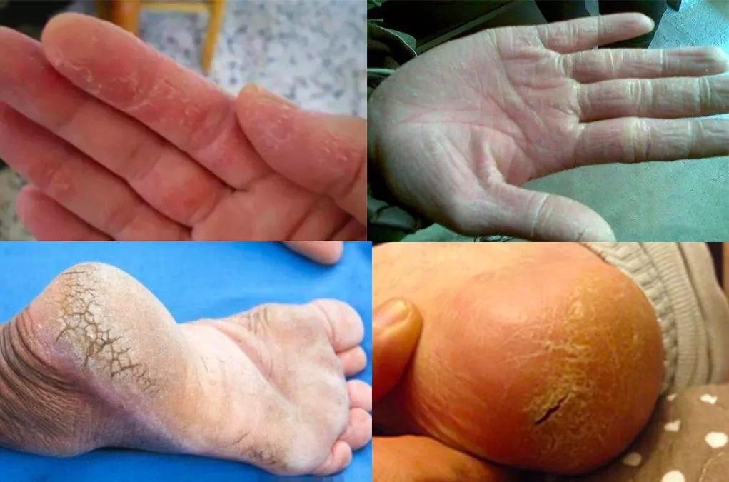 脚后跟老茧怎么去除,我的脚后跟有老茧变硬有细微开裂