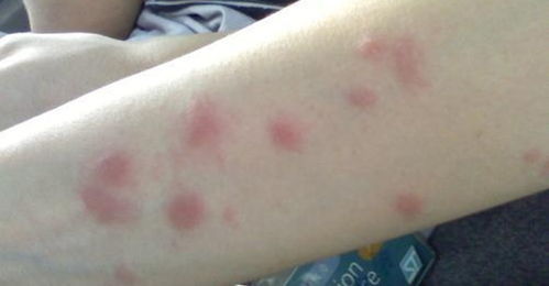 蚊子最爱o型和b型血,蚊子喜欢喝o型血这是真的吗