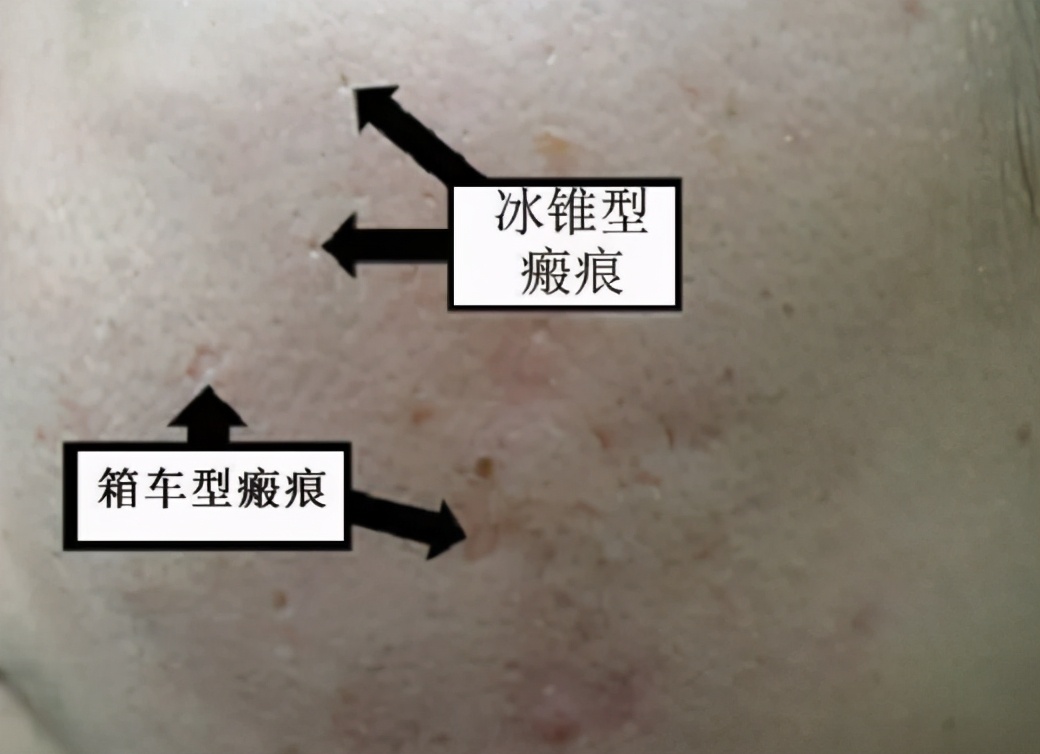 去除疮疤的最好方法,疮疤去除