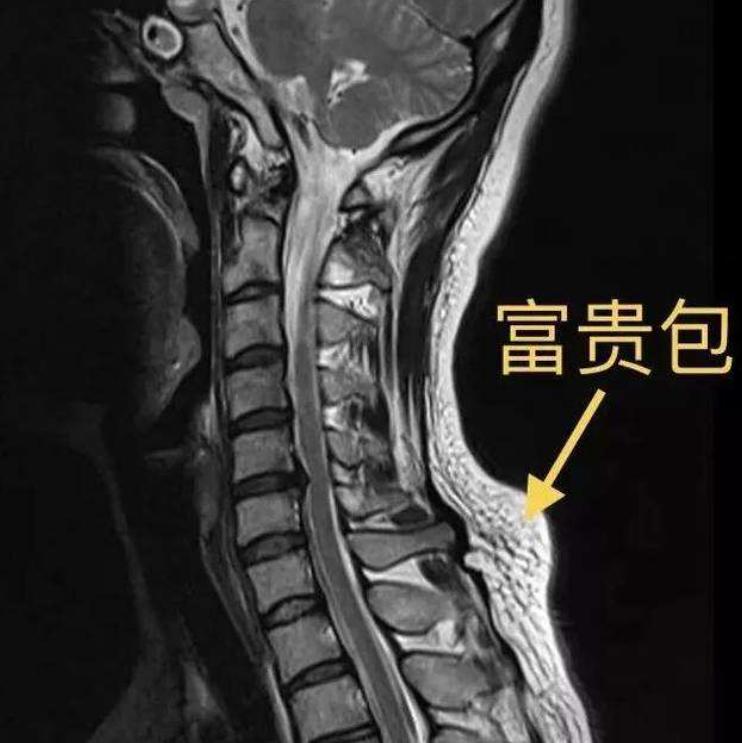 脖子后边的富贵包该怎么治疗,脖子后面的富贵包咋治呢