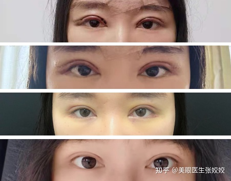 贴了双眼皮贴后的真实效果,贴双眼皮贴容易起翘