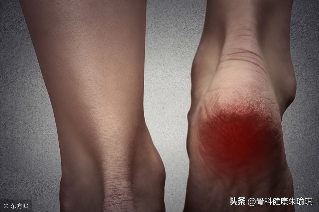 足跟长骨刺会导致足跟痛吗,足跟痛骨刺会一直痛下去吗