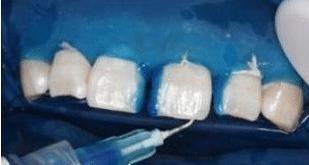 门牙缝可以补吗,为什么门牙有缝