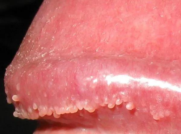 尖锐性湿疣应与什么疾病鉴别,尖锐性湿疣与其它病的鉴别