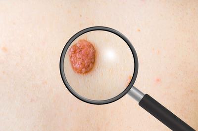 脂肪瘤怎么预防和注意事项,脂肪瘤预防和注意事项