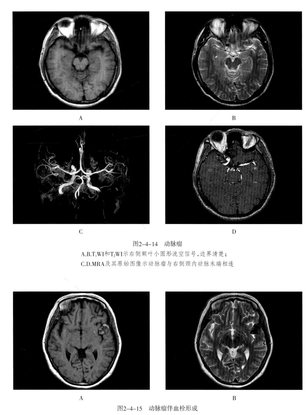 颅内血管轻度狭窄诊断标准,颅内血管先天变异影像