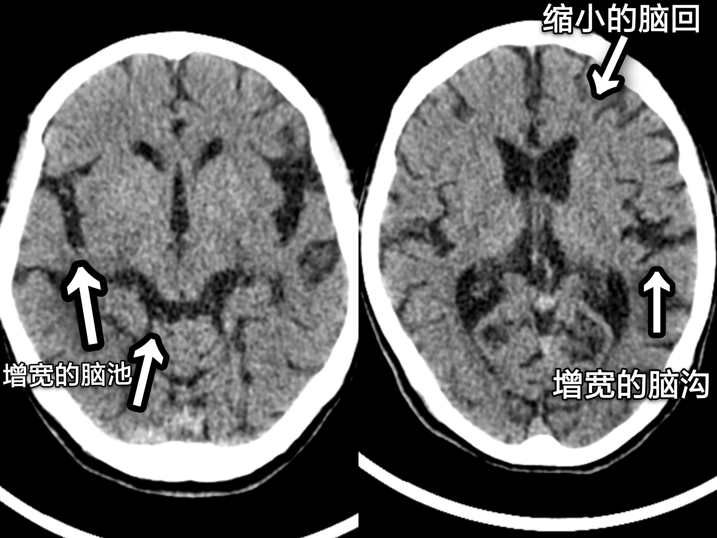 脑萎缩是什么病的征兆,什么叫脑萎缩有哪些症状