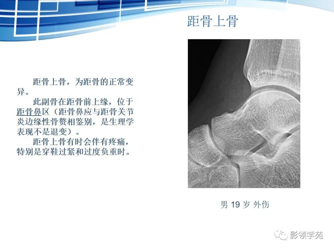 桡骨远端骨折引起尺骨变异,撕脱骨折一个月无明显骨痂形成