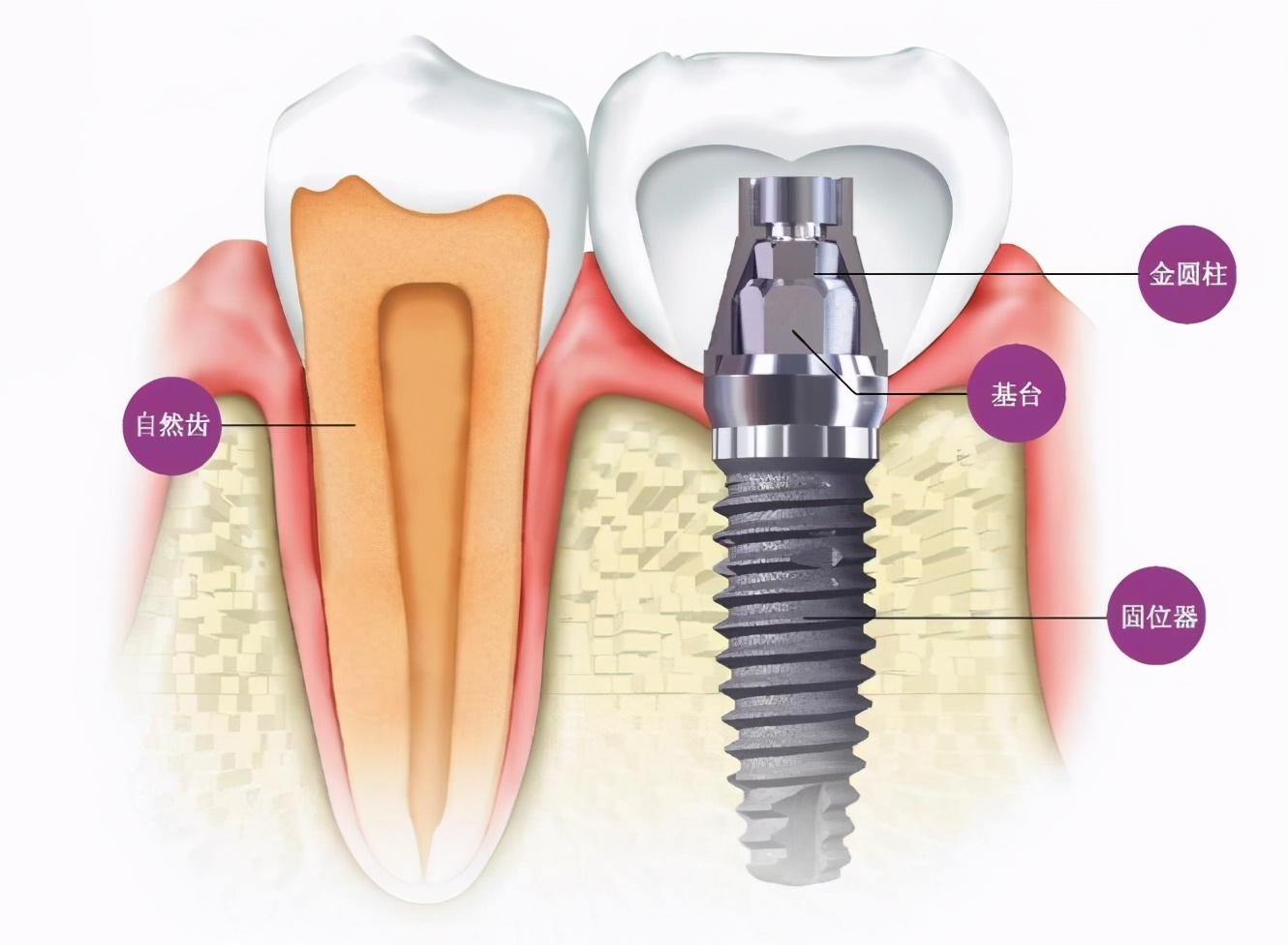 两千块种牙,上海雅悦齿科