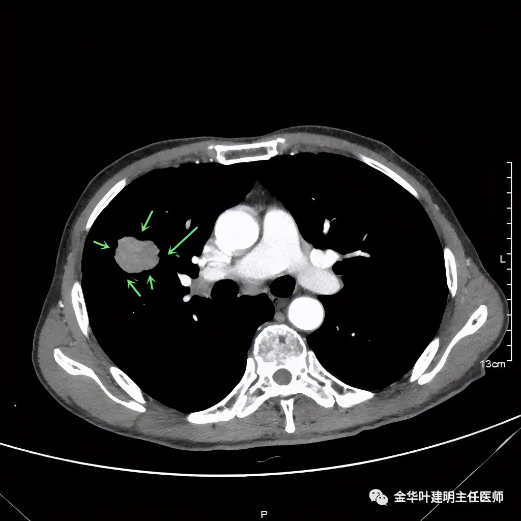 左肺占位被安排穿刺活检是肺癌吗,肺癌肺部穿刺有什么危险