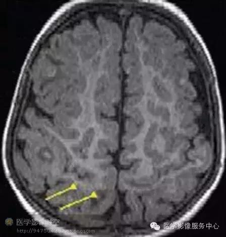 儿童癫痫CT表现,儿童各类癫痫脑电图特征