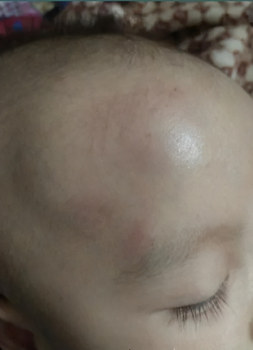 宝宝摔头起包后留下一个硬坨,宝宝头上摔了个包有没有潜伏期