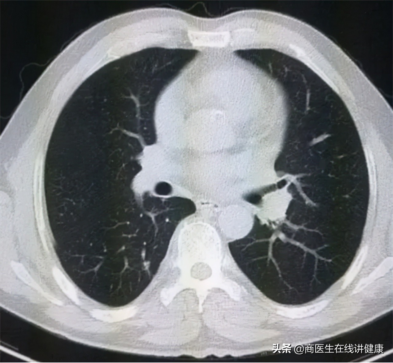 2厘米肺结节打消炎针能变小吗,肺结节5mm一年后去检查变小