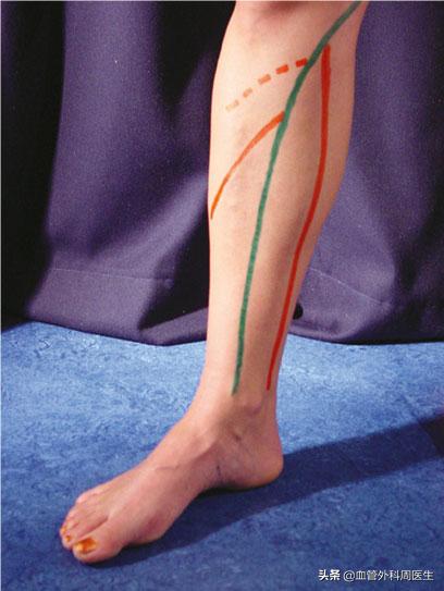 你了解静脉曲张吗,下肢静脉曲张常识