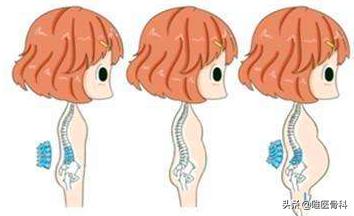 有腰间盘突出史的孕妈妈如何催产,怀孕后导致腰椎间盘突出怎么办