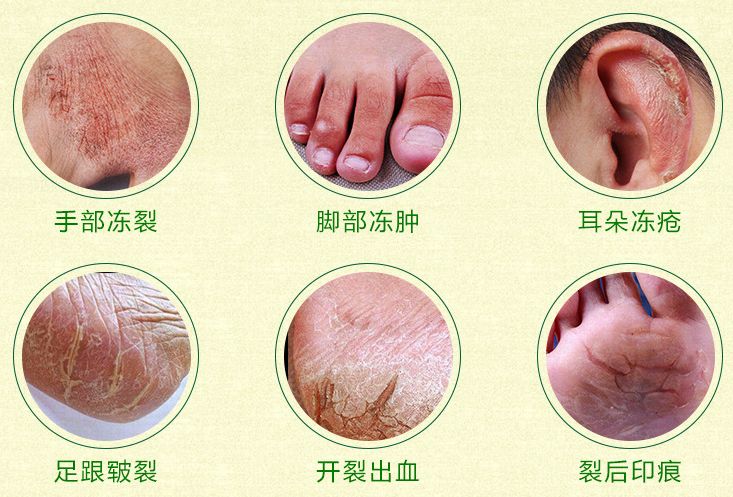 手脚干裂倒刺怎么治疗,手脚经常脱皮开裂最佳治疗方法