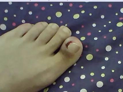 甲沟炎自愈的经历,甲沟炎的亲身经历