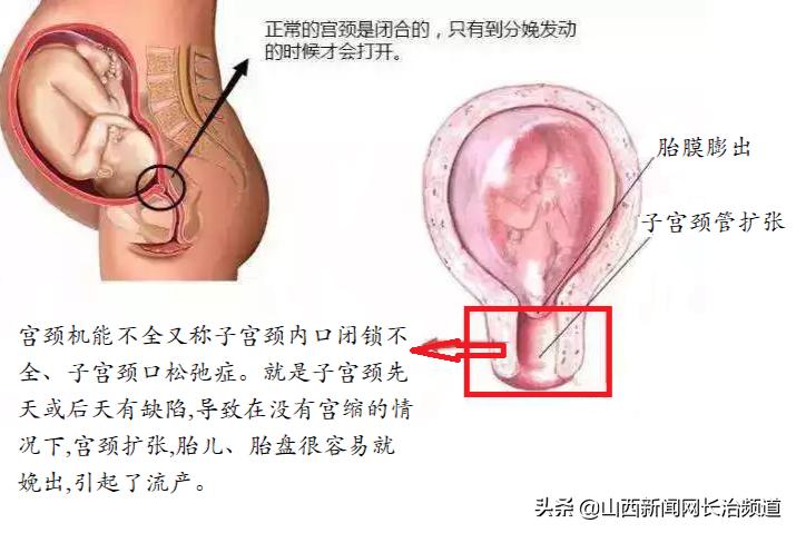 【特色】最美“蝴蝶结”——长治市妇幼保健院送给中晚期反复流产妈妈的礼物