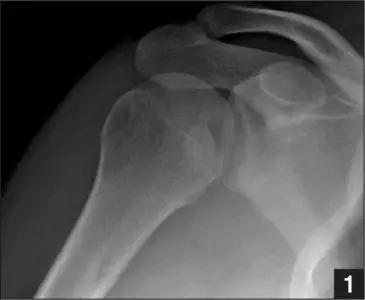 特殊骨折类型,特殊骨折体征