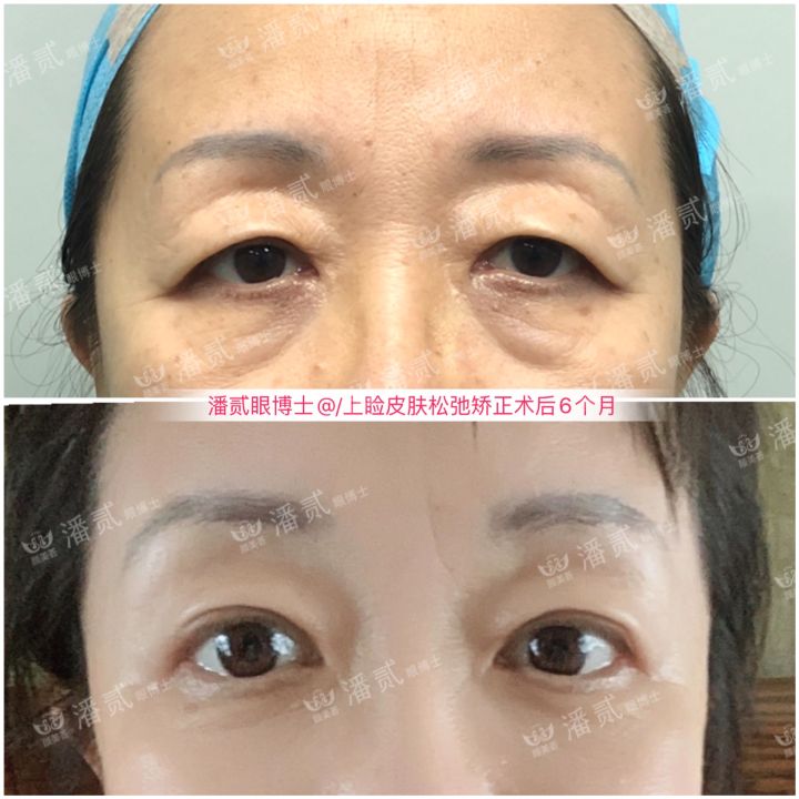 割了开扇双眼皮眼尾上扬太宽,眼尾上扬的眼睛适合什么双眼皮