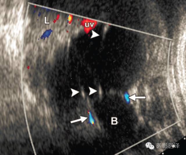 孕早期卵巢囊肿边界清形态规则,孕期卵巢囊肿呈液性伴点状回声