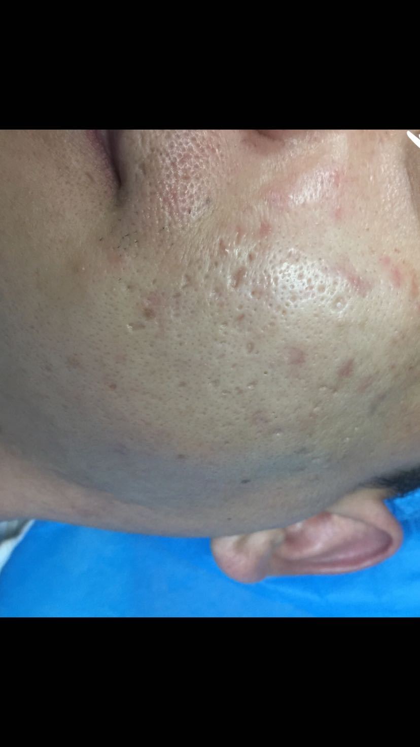 治疗疔疮最好的外用药,痔疮的外用药膏