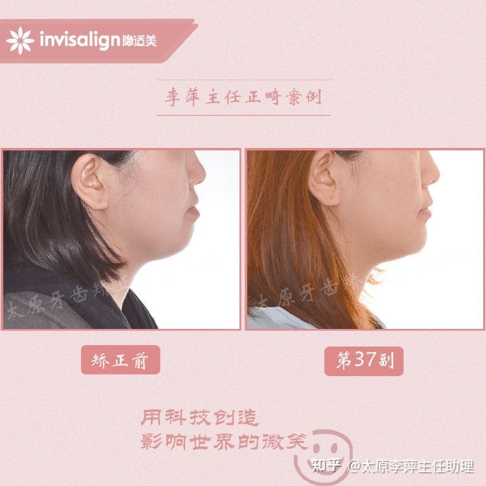 重度拥挤矫正牙齿适合隐形牙套吗,广州成人牙齿矫正推荐隐形牙套