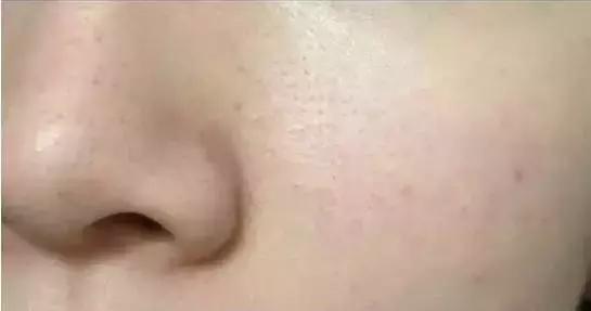 黑头可以用什么药膏来治疗,鼻子上的黑头怎么来的