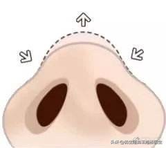 鼻尖高了怎么修复,鼻尖太大怎么矫正
