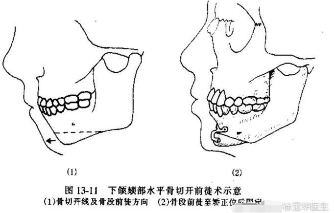 正畸矫正骨性难还是牙性难,骨性正畸和牙性正畸