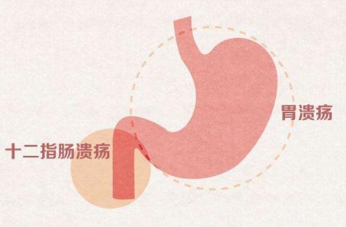 老年人胃溃疡是什么引起,老年人胃溃疡是什么原因引起的啊