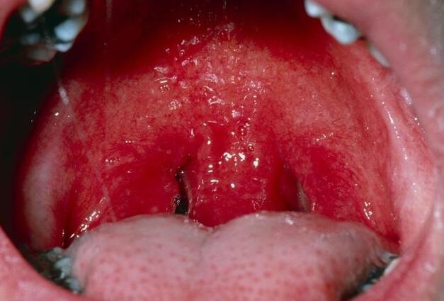 急性咽喉炎和咽炎的区别,为什么慢性咽喉炎反复发作