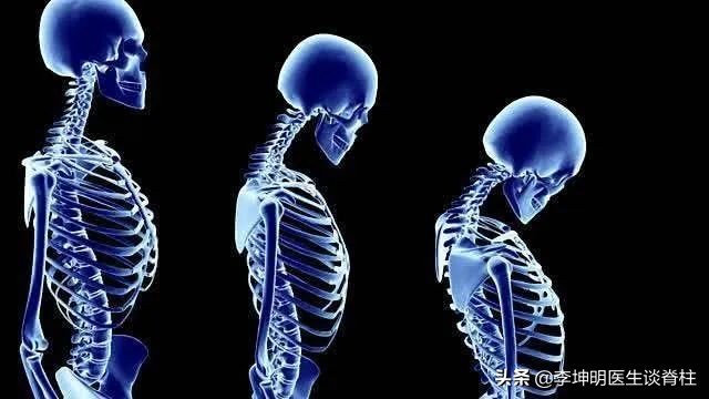 李坤明医生提醒你:颈椎相关疾病的治疗和预防,二)颈椎病(1)