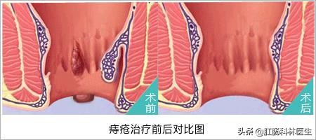 预防痔疮发作可以吃哪些东西,痔疮术后的注意事项及预防