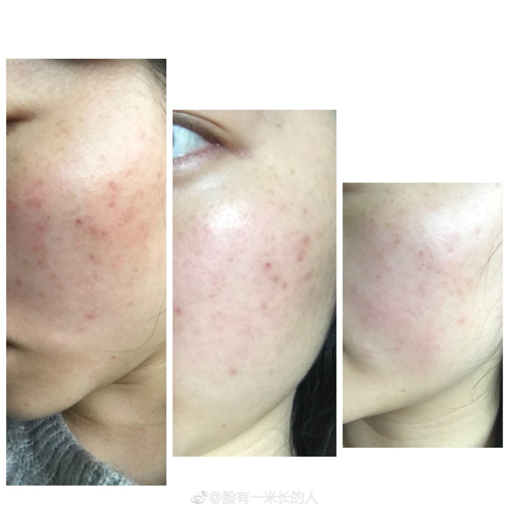 祛痘印敏感肌肤最有效的方法,敏感肌淡斑祛痘印