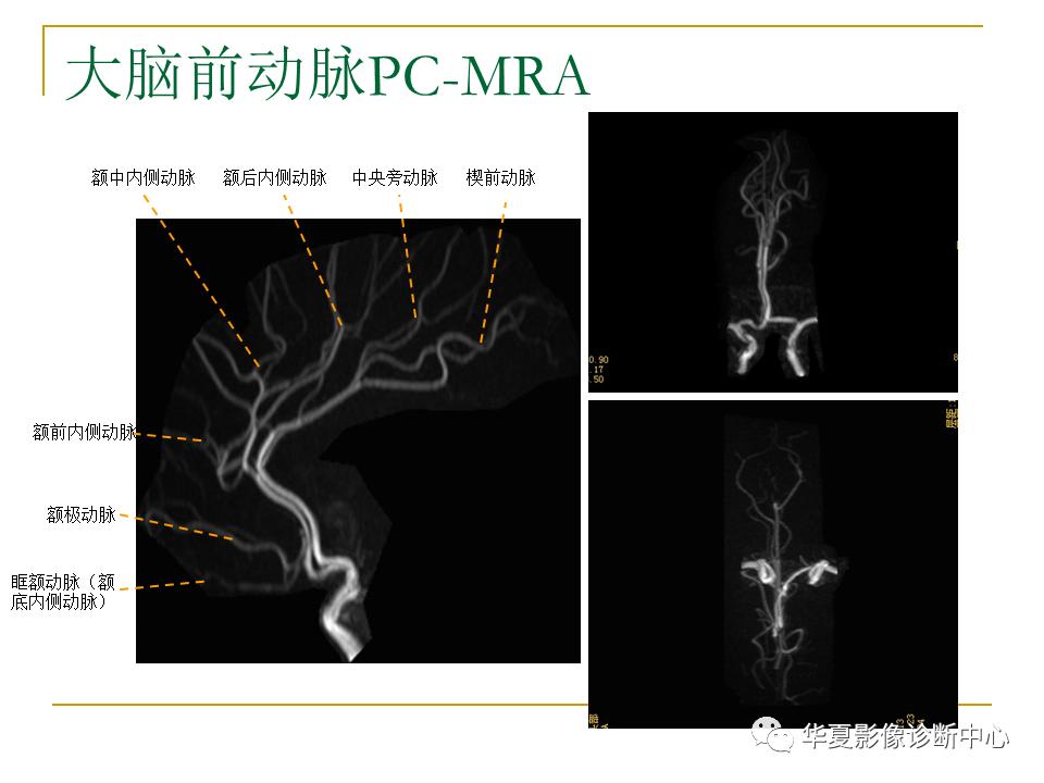 中国人脑立体定向mri应用解剖图谱,脑mri示意图