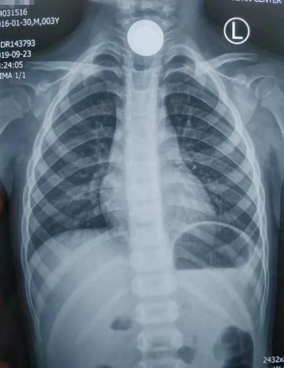 三岁的孩子不小心吞了一个水宝宝,一岁宝宝不小心吞了一颗糖怎么办