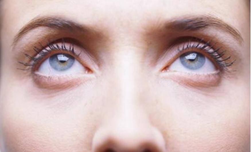 眶隔释放去眼袋后有凹陷怎么回事,做了眼袋手术凹陷下去了能填充吗