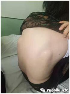硬纤维瘤超声表现,背部弹力纤维瘤看哪个科室
