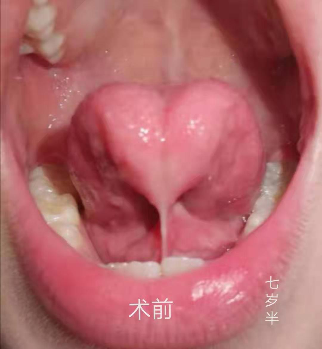 剪舌系带的全过程有危险吗,孩子舌系带矫正术