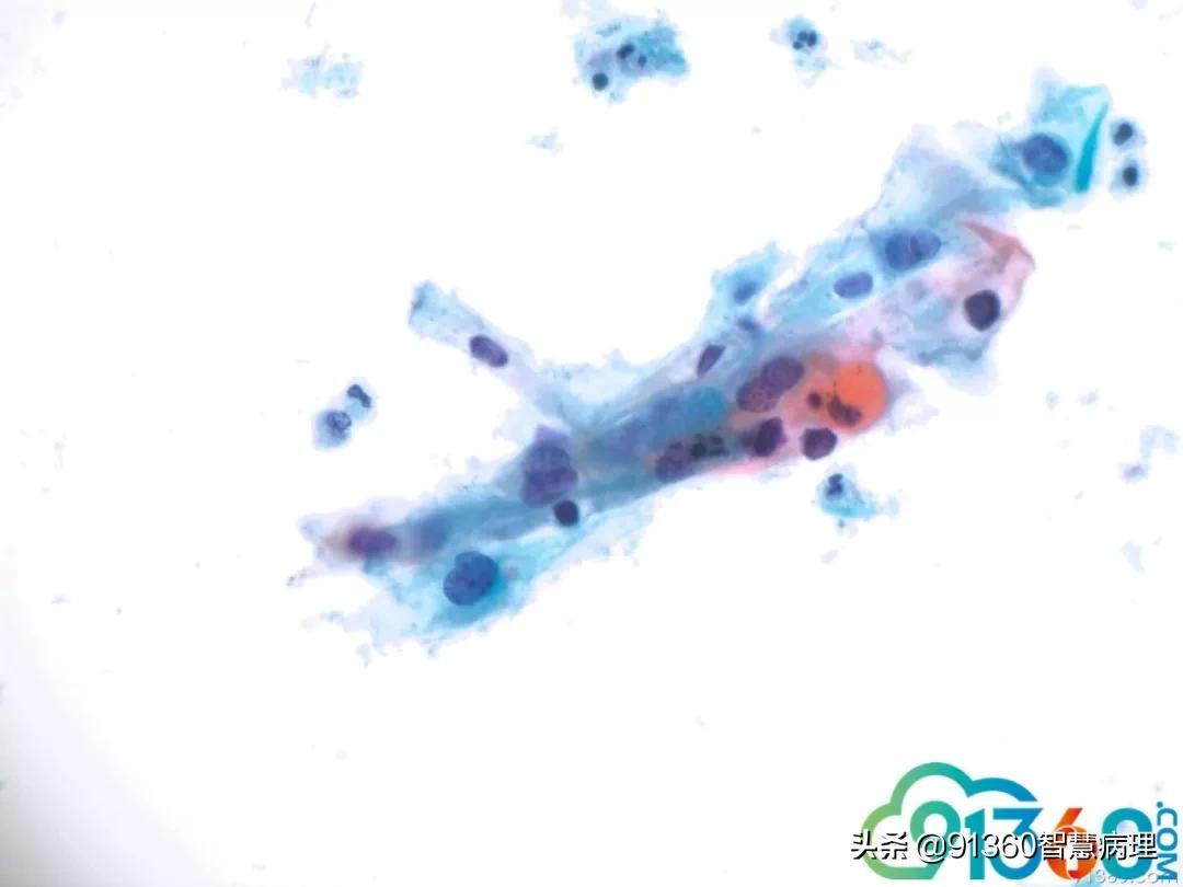 宫颈病理检查与tct检查的区别,病理诊断宫颈活检鳞癌