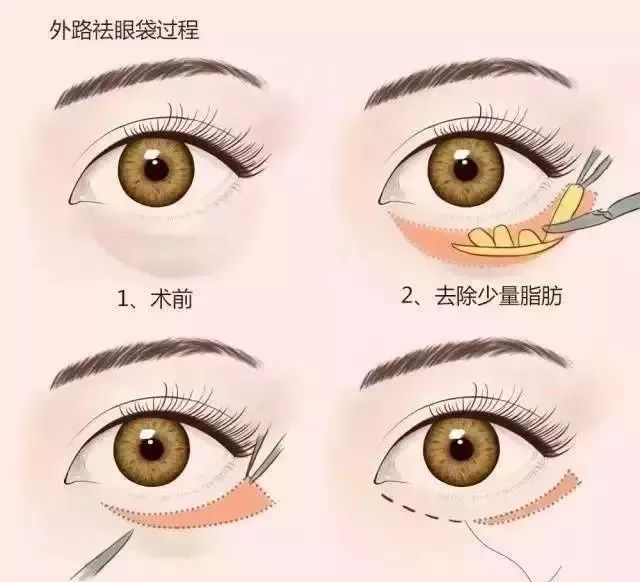 眼袋消除三个方法,教你一个简单消除眼袋的方法