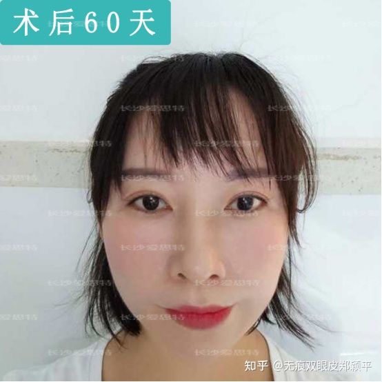 刚割双眼皮的样子,割双眼皮增生是什么样子